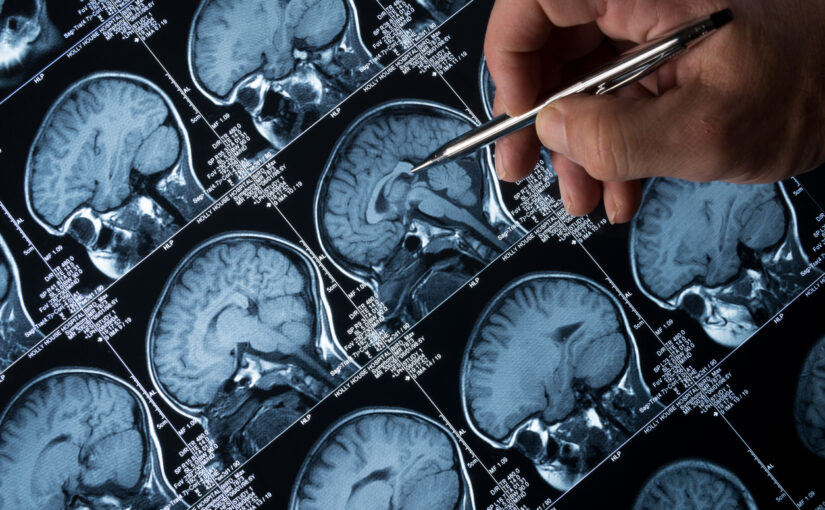 MRI Brain Scan of head and skull with hand pointing